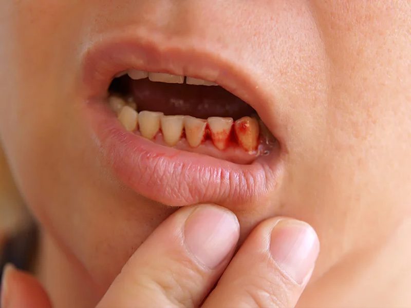 What Are The Causes And Symptoms Of Blood Blister In Mouth 