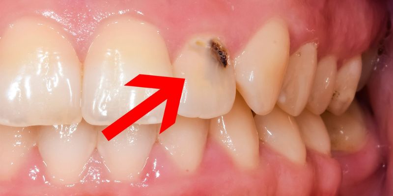 What Does a Cavity Look Like?